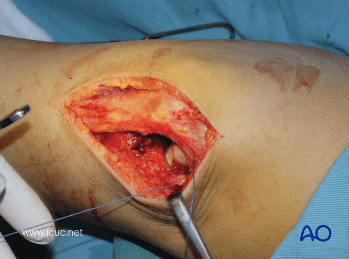 Avulsion of tibial spine – repair of medial parapatellar retinaculum and capsule