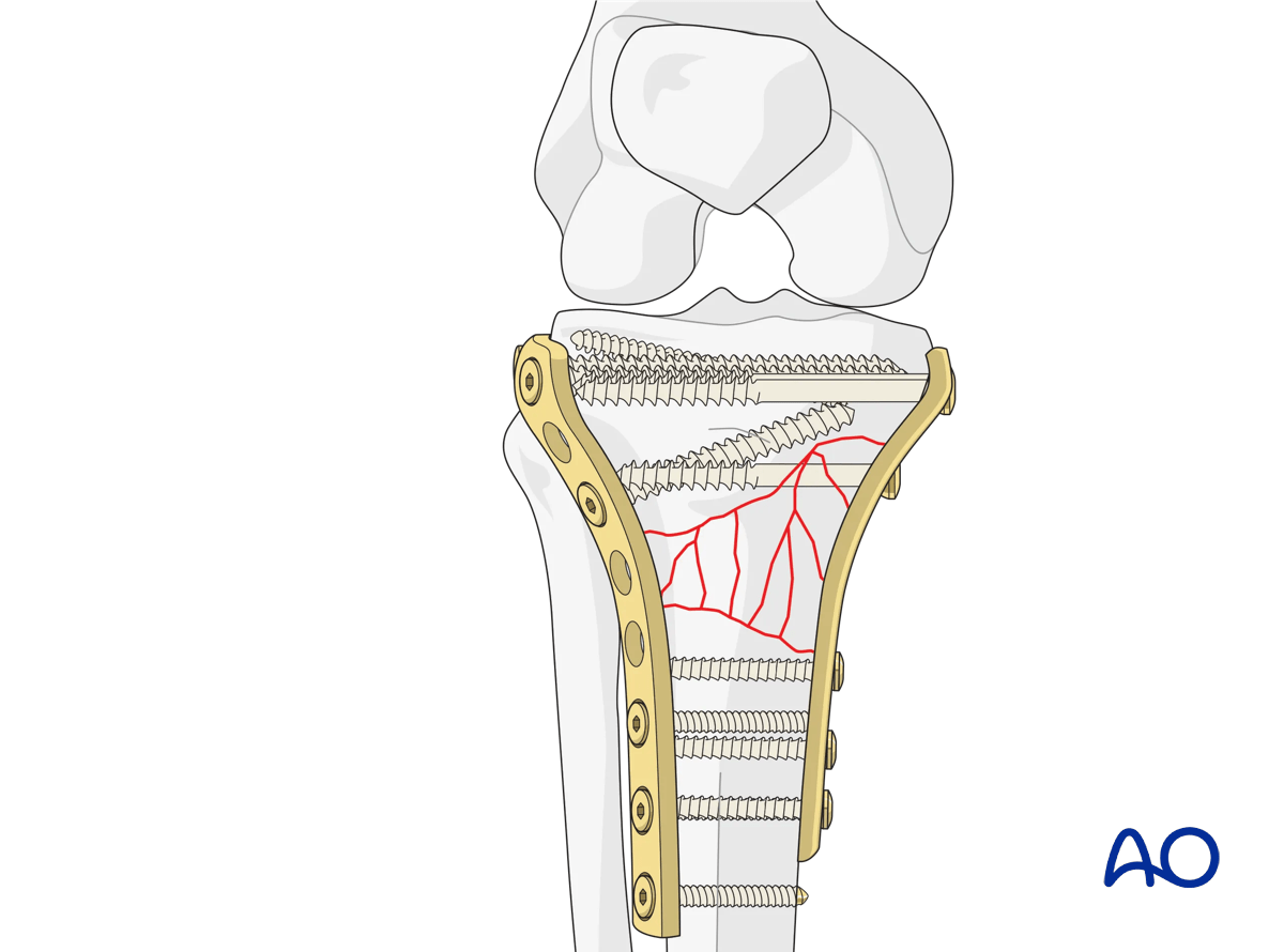 ORIF - Conventional plating, double plating
