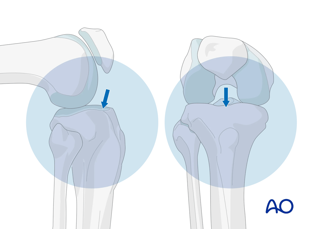 Suprapatellar intramedullary nailing, Obtaining appropriate fluoroscopic views of the proximal tibia