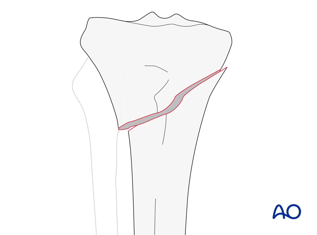 Extraarticular fracture, metaphyseal simple (AO/OTA 41A2)