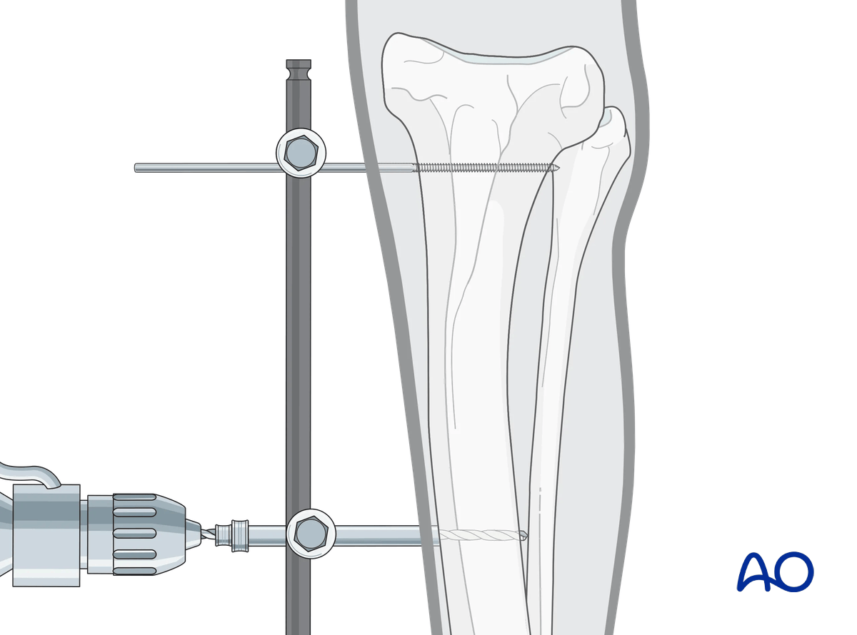 General considerations on external skeletal fixators