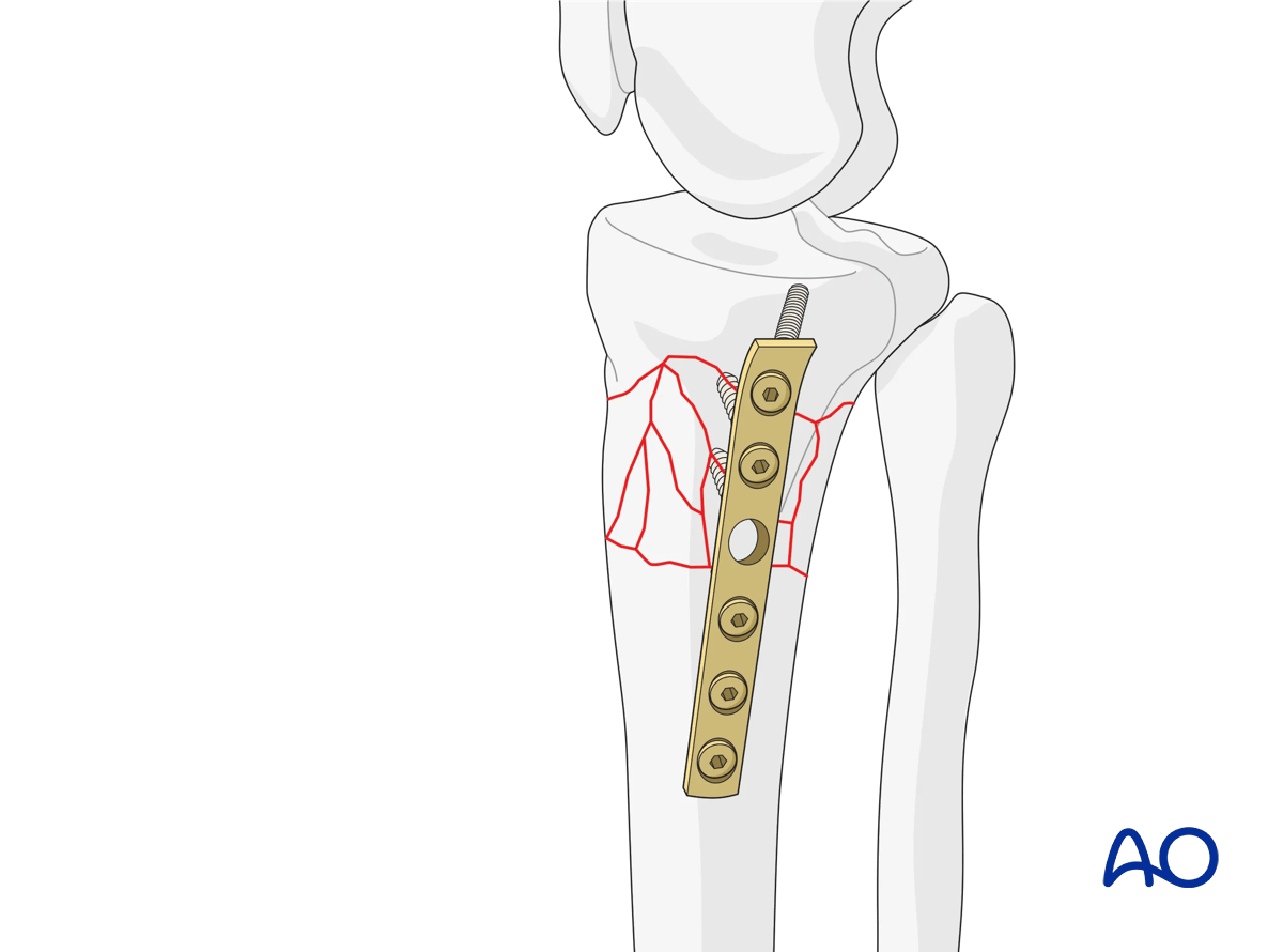 ORIF - Conventional plating, medial column fixation
