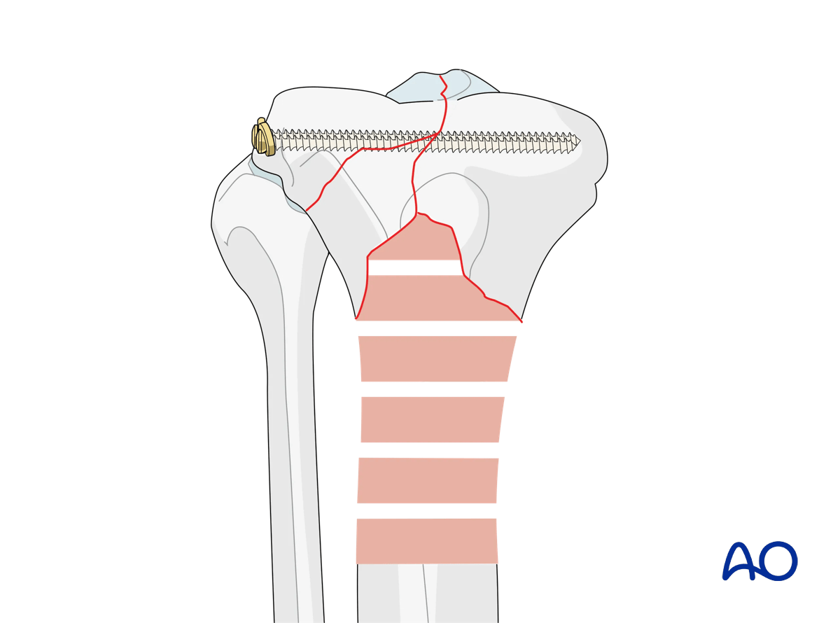 Proximal tibia fracture – ring fixation: fracture fixation