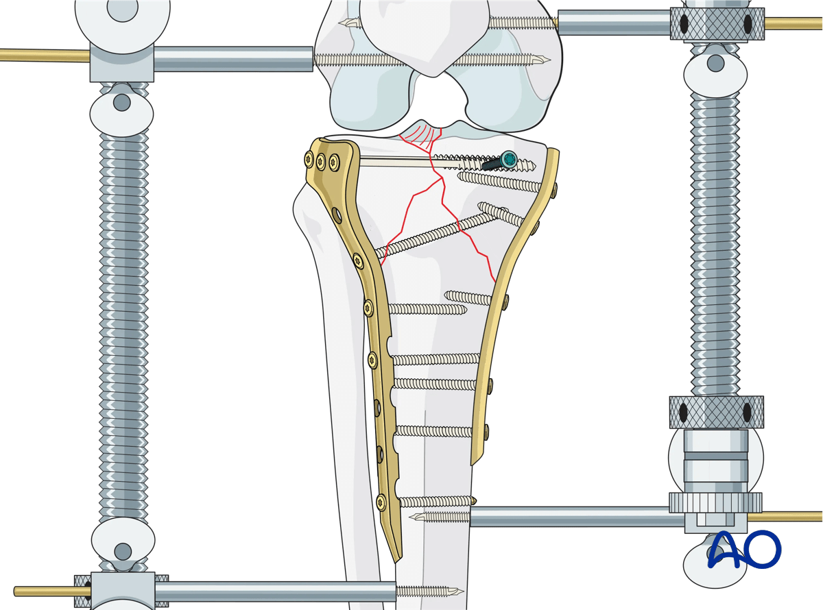 Proximal tibia - Complete articular fracture with fragmentary medial plateau: fixation of lateral column