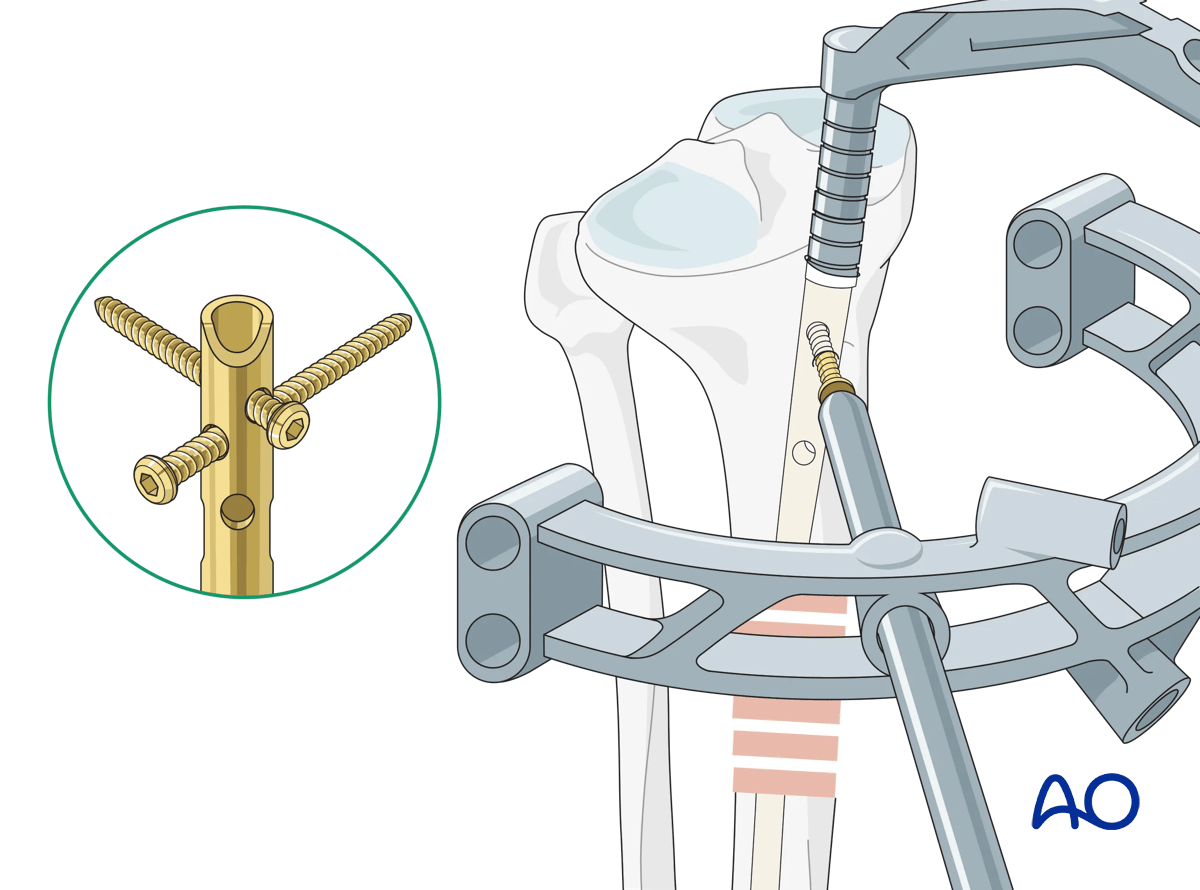 Suprapatellar intramedullary nailing, proximal locking