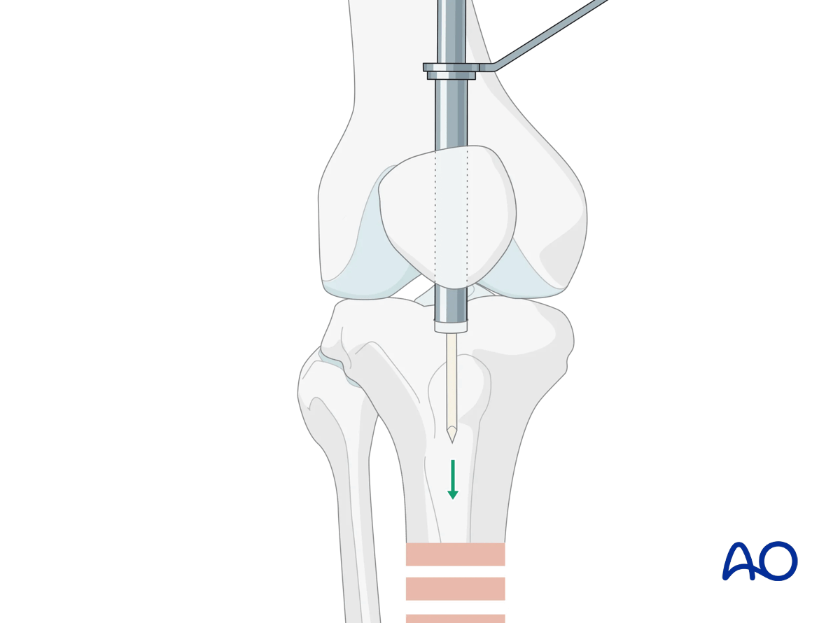 Suprapatellar intramedullary nailing, insertion of the guide wire