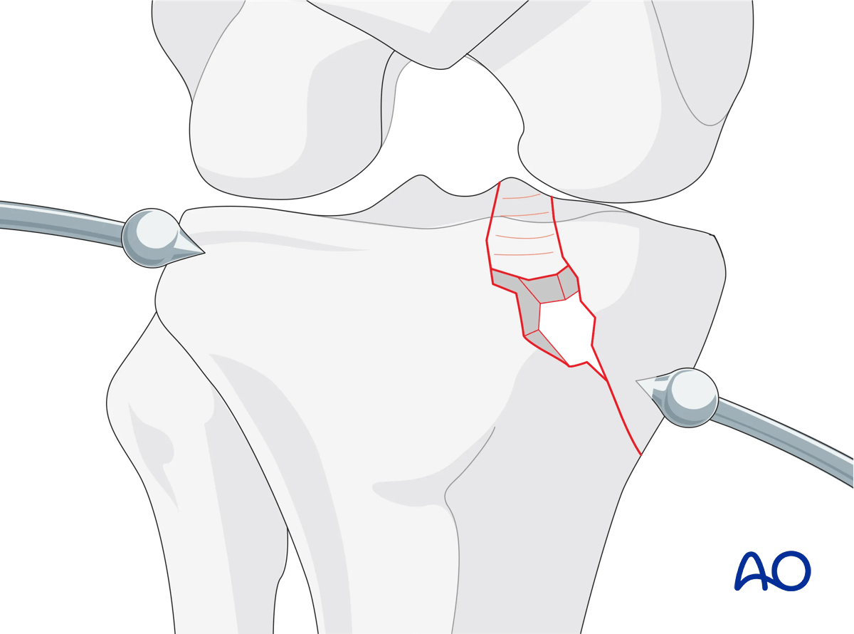 ORIF - Conventional plating, reduction of the medial articular surface