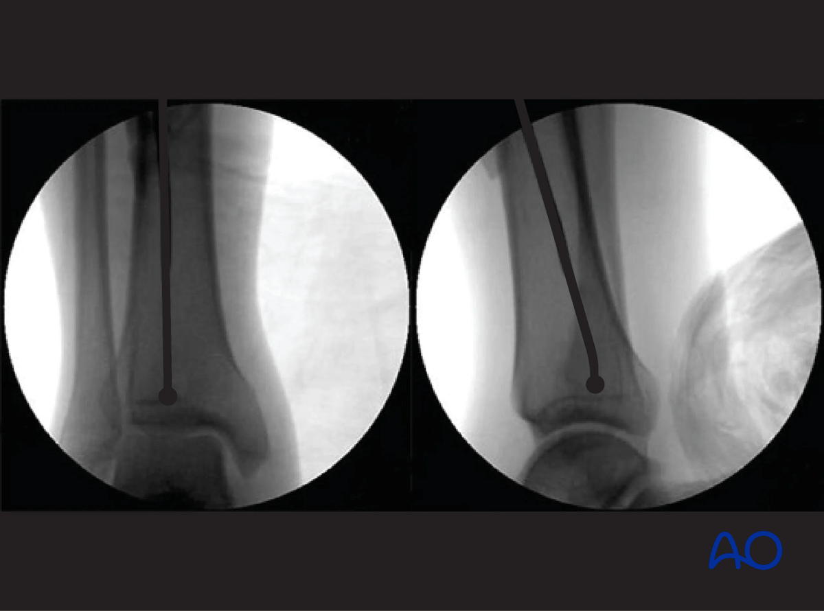 Tibia intramedullary nailing - fluoroscopic control