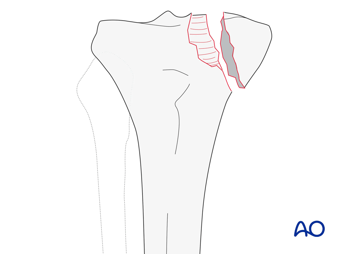 Medial plateau fracture (AO/OTA 41B3.2)