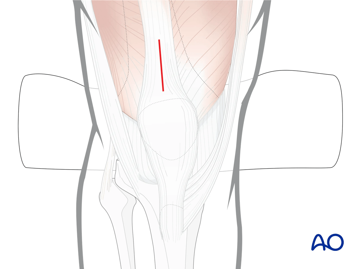 Proximal tibia: semi extended suprapatellar approach for intramedullary nailing of the tibia - incision