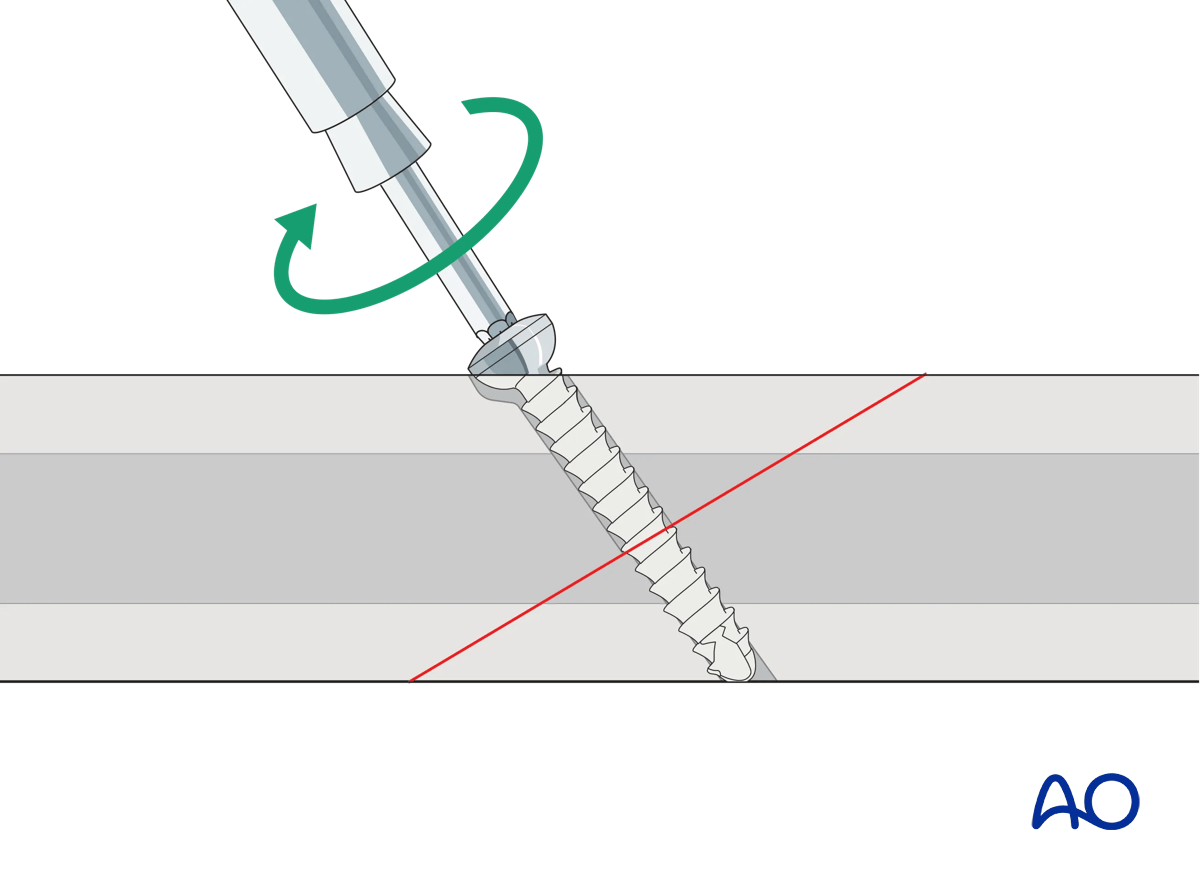 Insertion of self-tapping screw