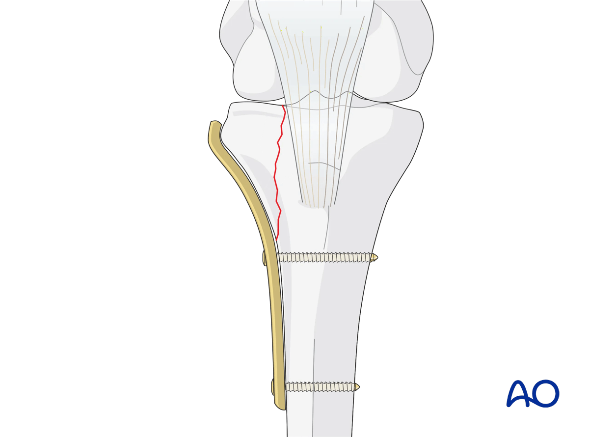 ORIF - Conventional plating, Fixation of the lateral column