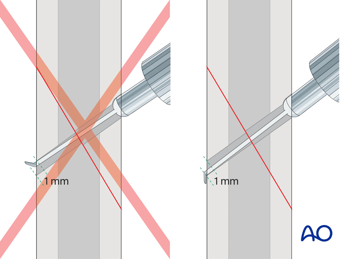 Determination of screw length