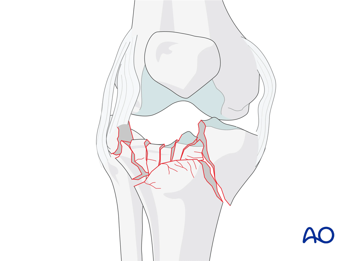 ORIF - Conventional plating, Complete articular fracture, fragmentary articular lateral