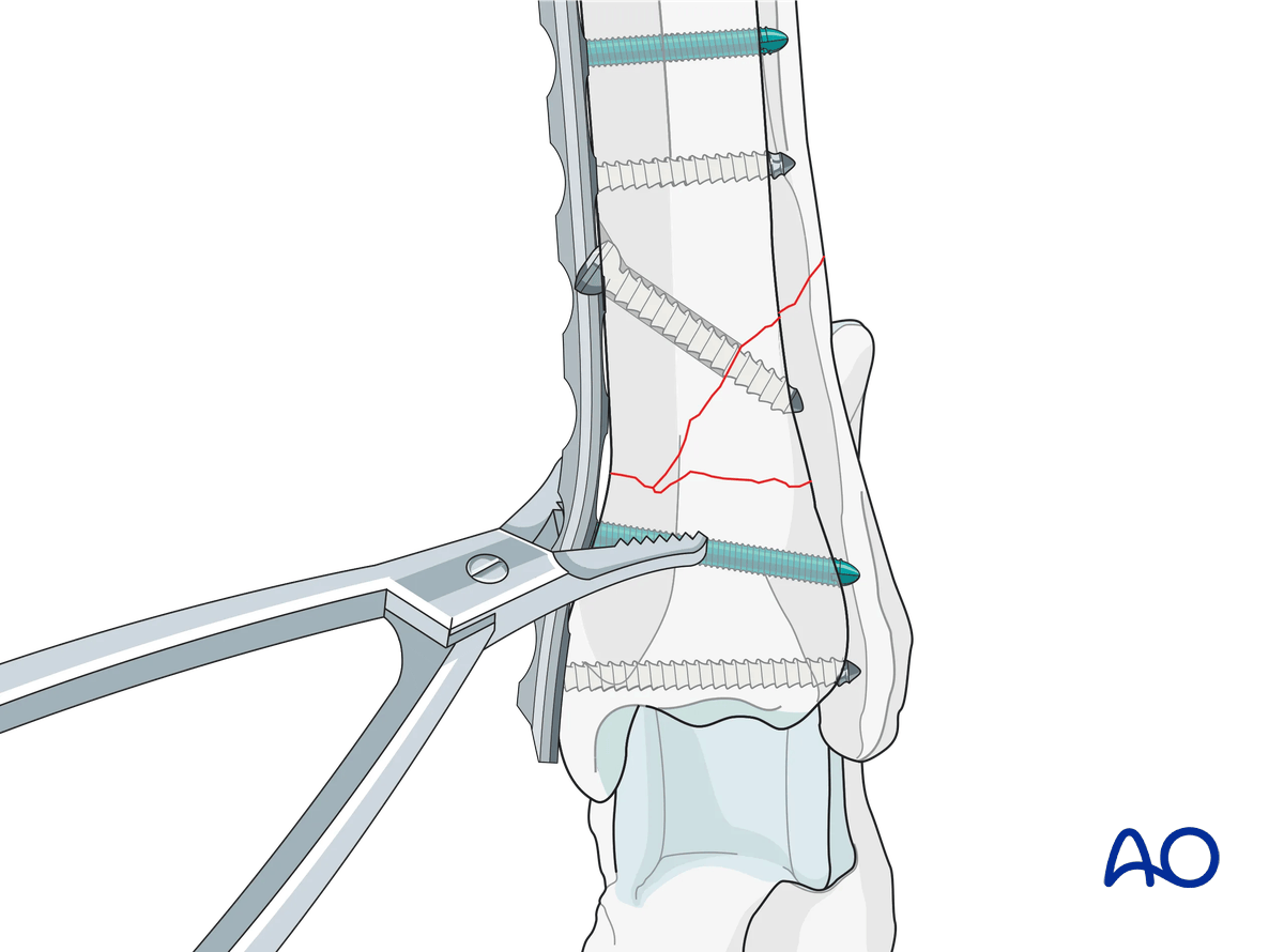 Neutralization plating (plate and lag screw) for Extraarticular wedge ...