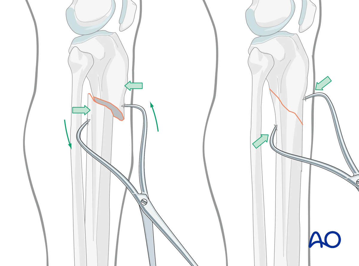 Suprapatellar intramedullary nailing, Percutaneous reduction forceps