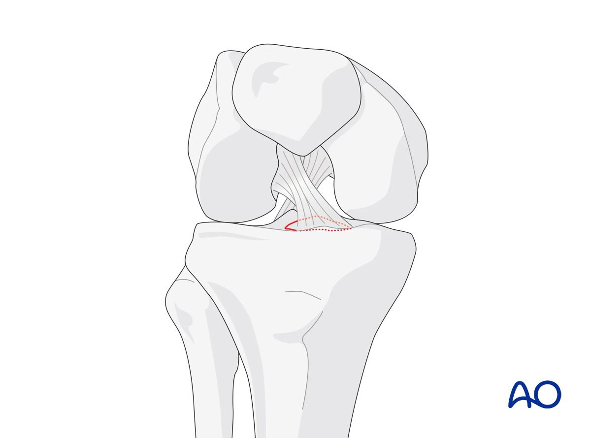 Tibial spine (AO/OTA 41A1.3)