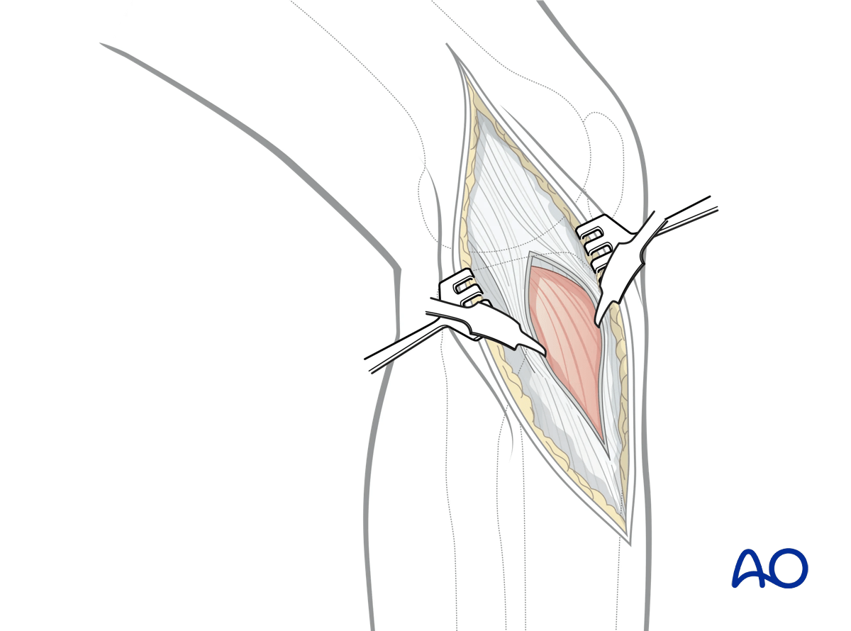 Anterolateral approach to the proximal tibia: opening the fascia