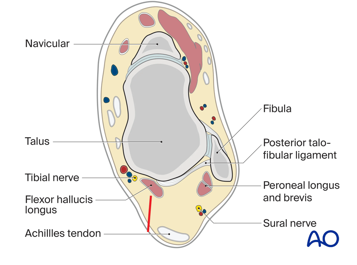 Protect neurovascular structures behind the medial malleolus