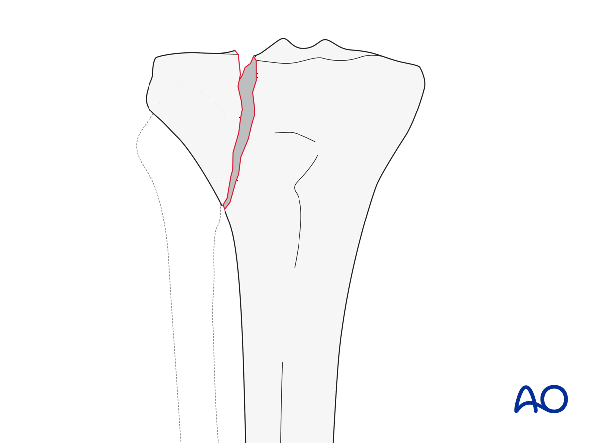 Split of the lateral surface (AO/OTA 41B1.1)