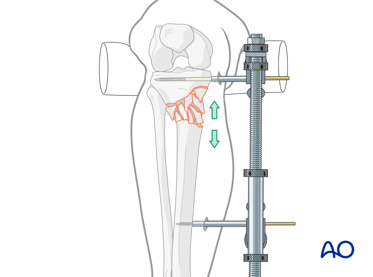 Proximal tibia: Wedge or multifragmentary extraarticular fracture Angular stable plating – indirect reduction