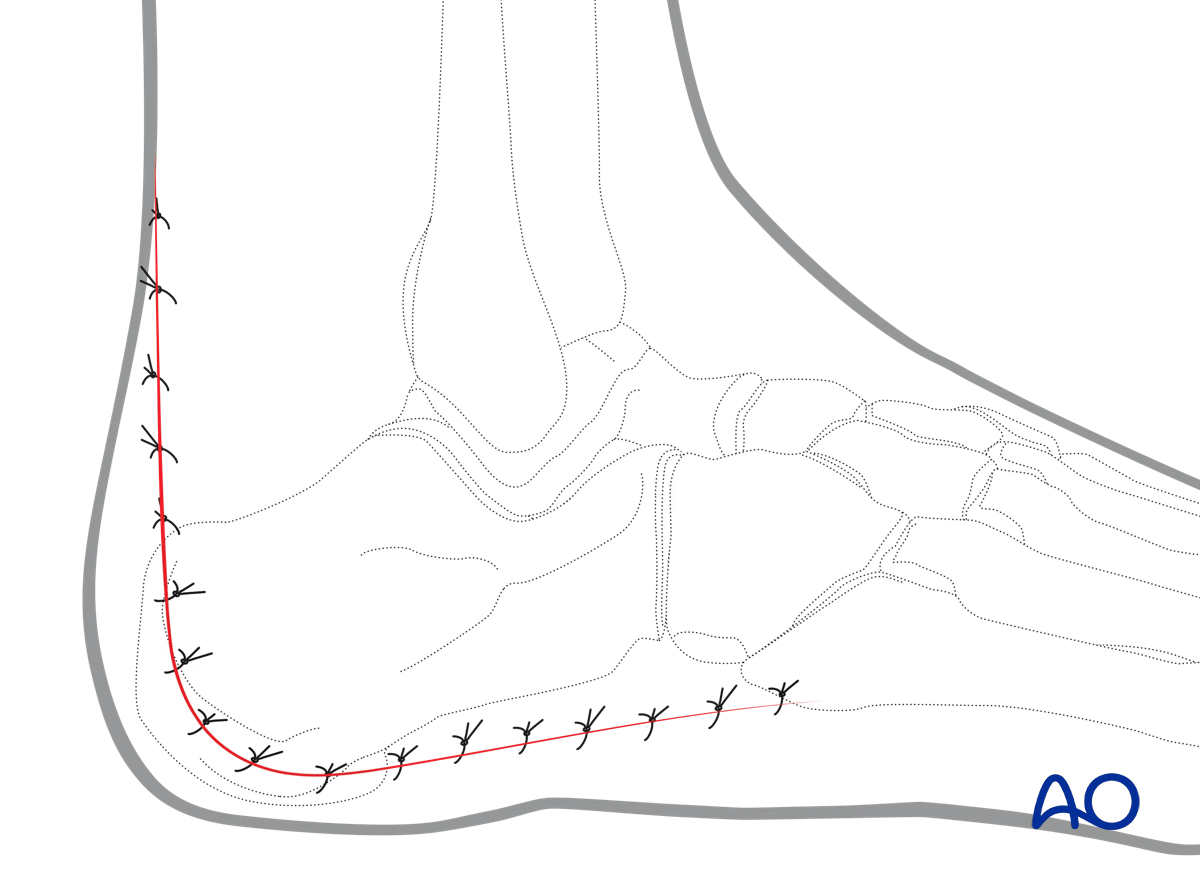 Extended lateral approach to the calcaneus: layered soft-tissue closure with absorbable sutures; drain optional
