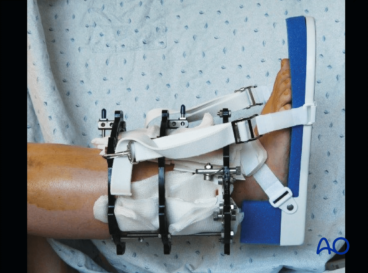 Proximal tibia fracture – ring fixation: static splinting of the ankle in the neutral position