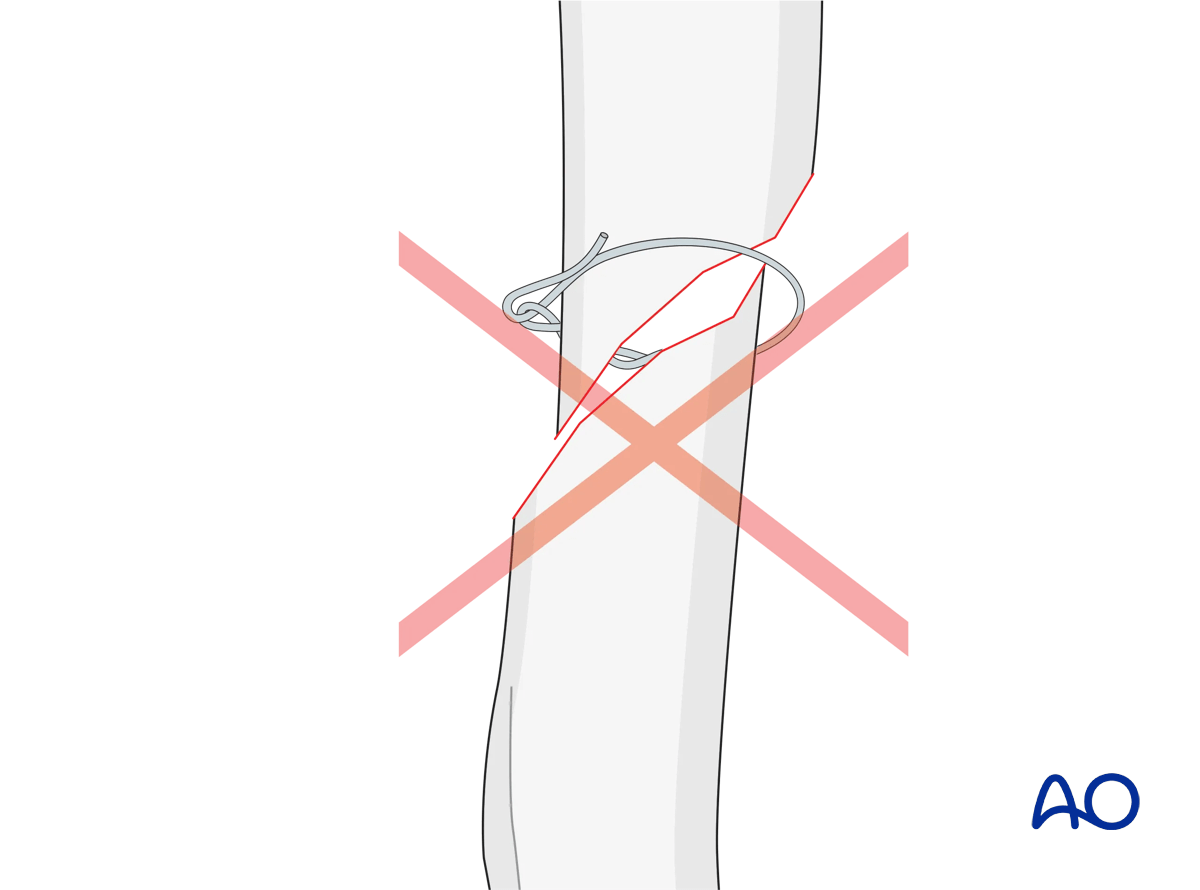 Cerclage wiring of a short oblique fracture impossible