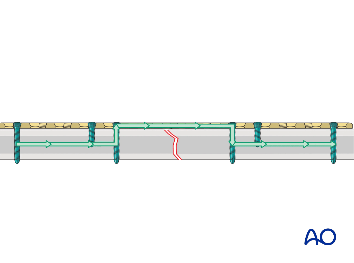 Load-bearing implant