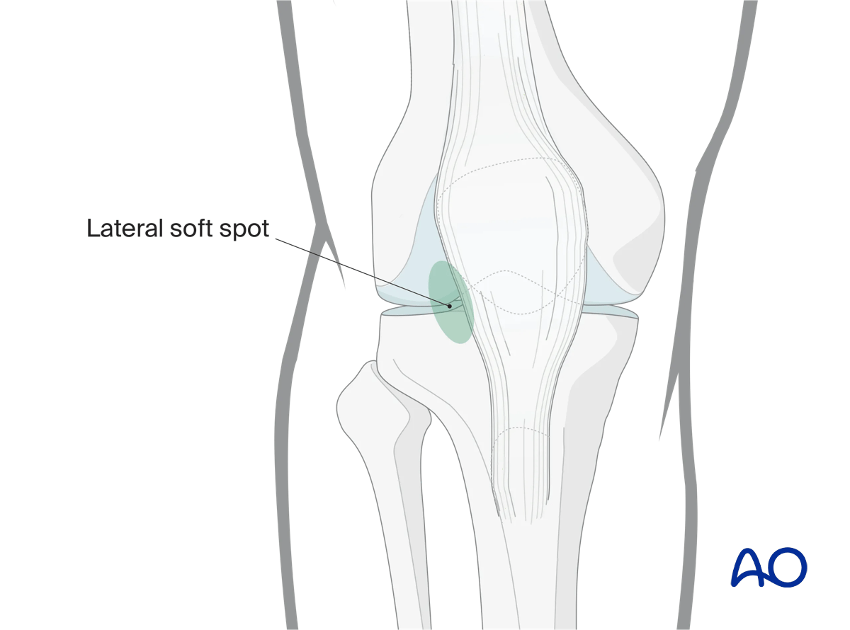 Arthroscopic approach to the knee, Anterolateral port