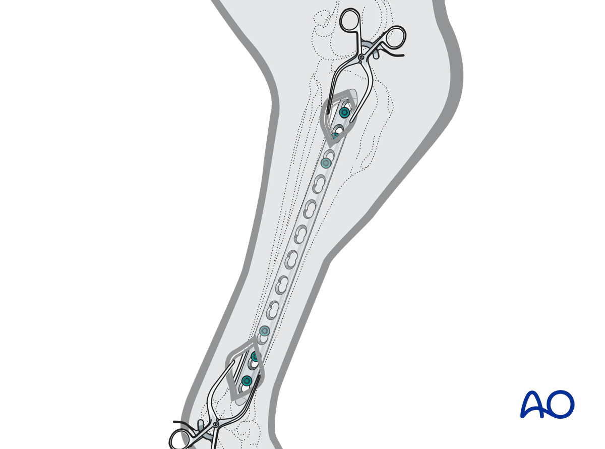 Illustration showing minimally invasive bridge plate insertion with screws placed through limited or small stab incisions.