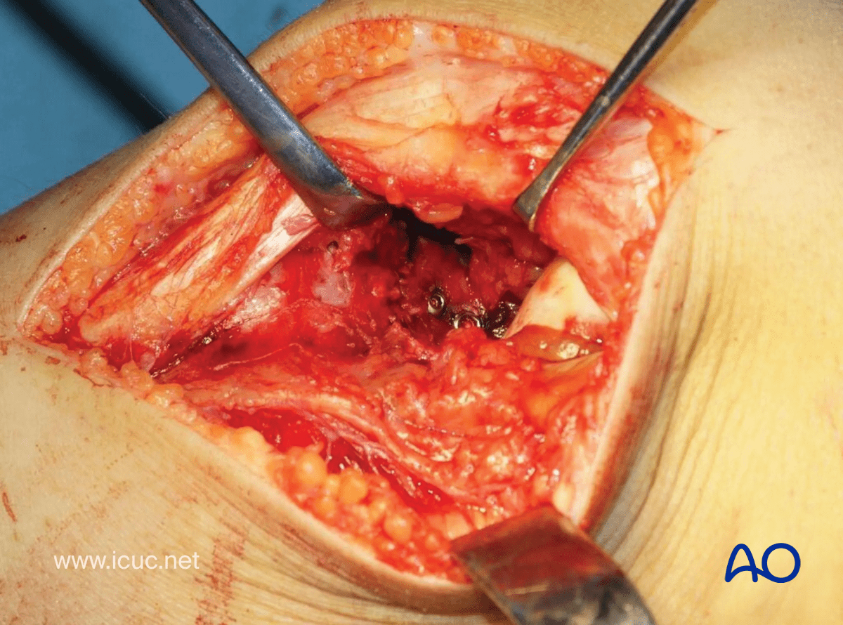 Avulsion of tibial spine – final intraoperative view of the tibial plateau