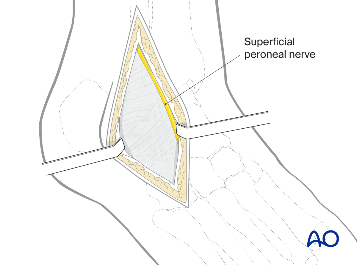 Lateral malleolar osteotomy protect superficial peroneal nerve; identify anteriorly or avoid via incision placement