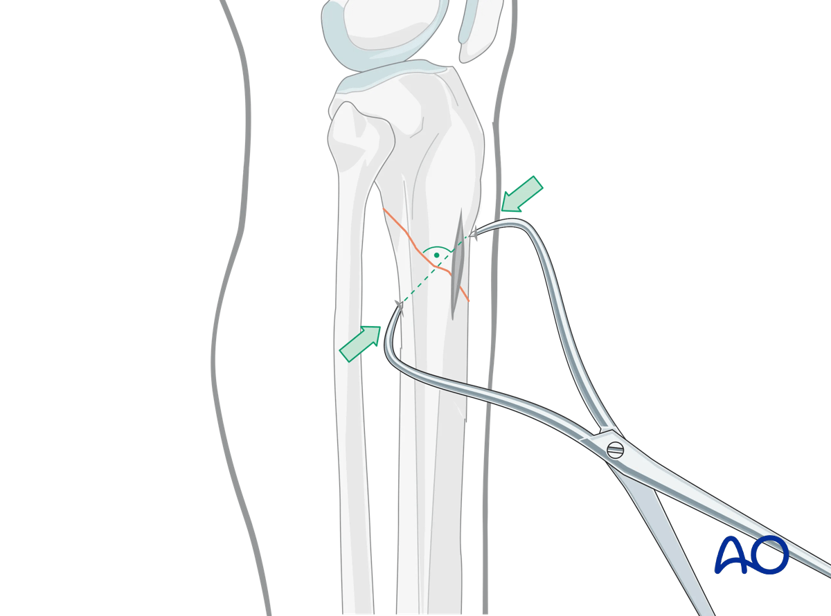 Suprapatellar intramedullary nailing, reduction of oblique fractures 