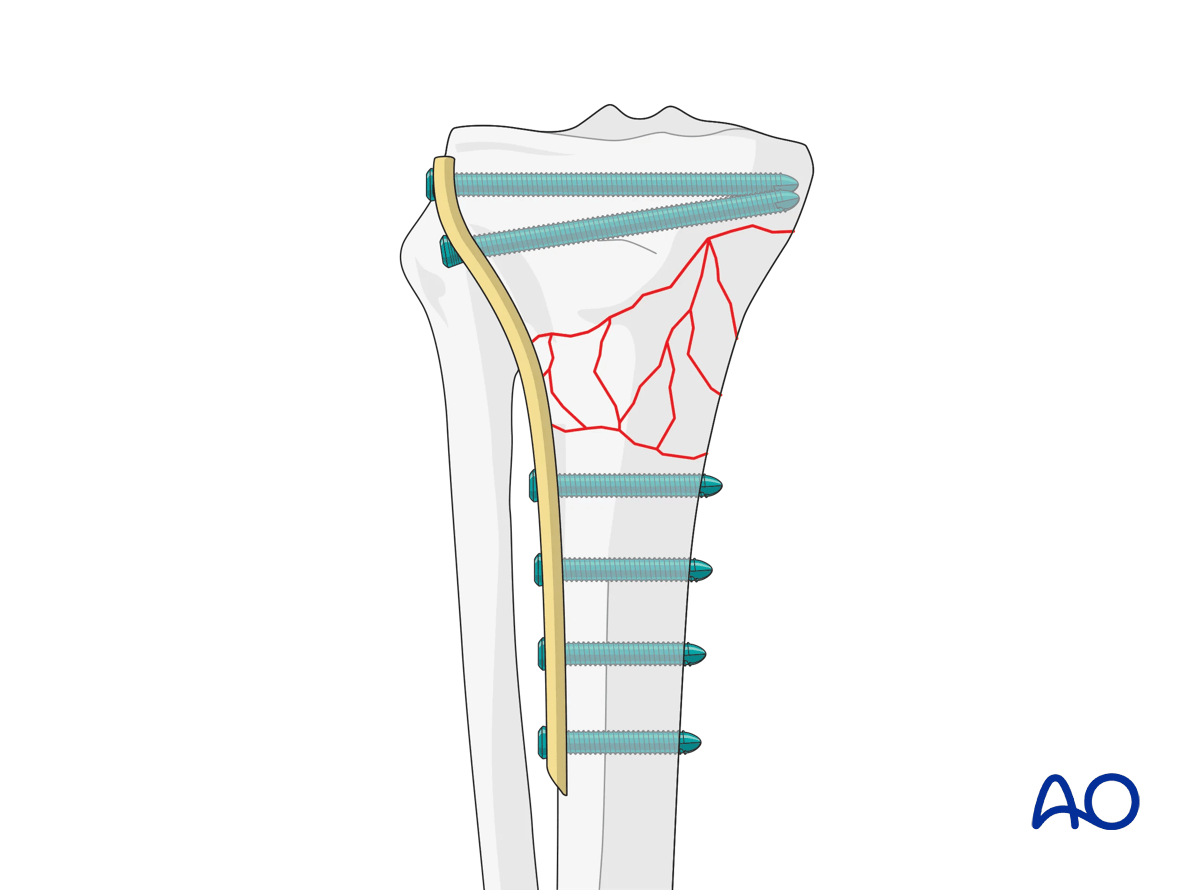 Proximal tibia: Wedge or multifragmentary extraarticular fracture Angular stable plating – final construct.