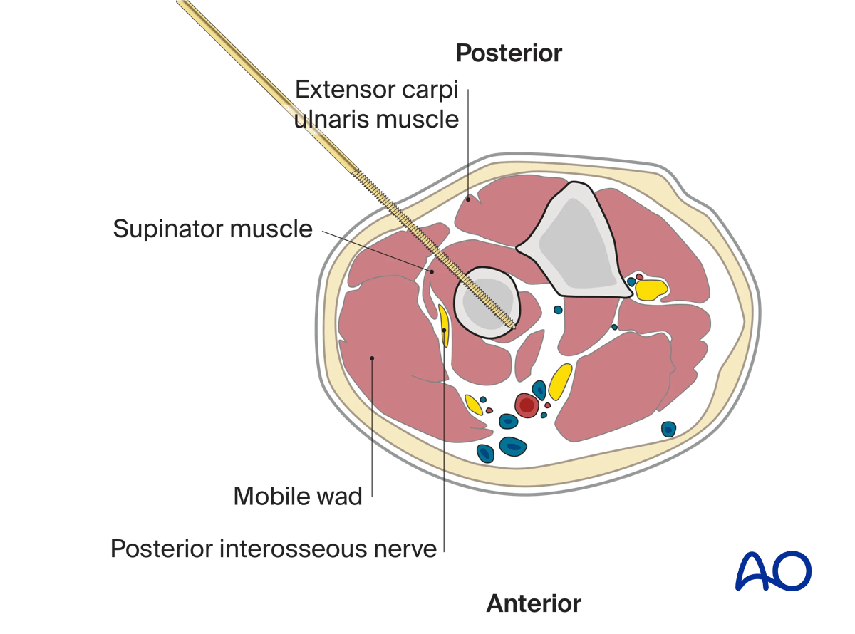 This cross section illustrates a pin inserted into the proximal third of the radius