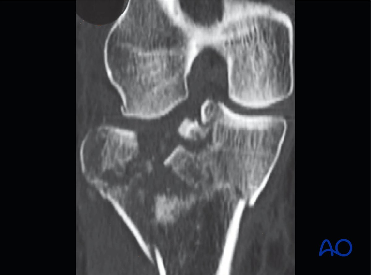 Proximal tibia - Coronal image showing simple medial condyle fracture and markedly depressed comminuted lateral plateau fracture