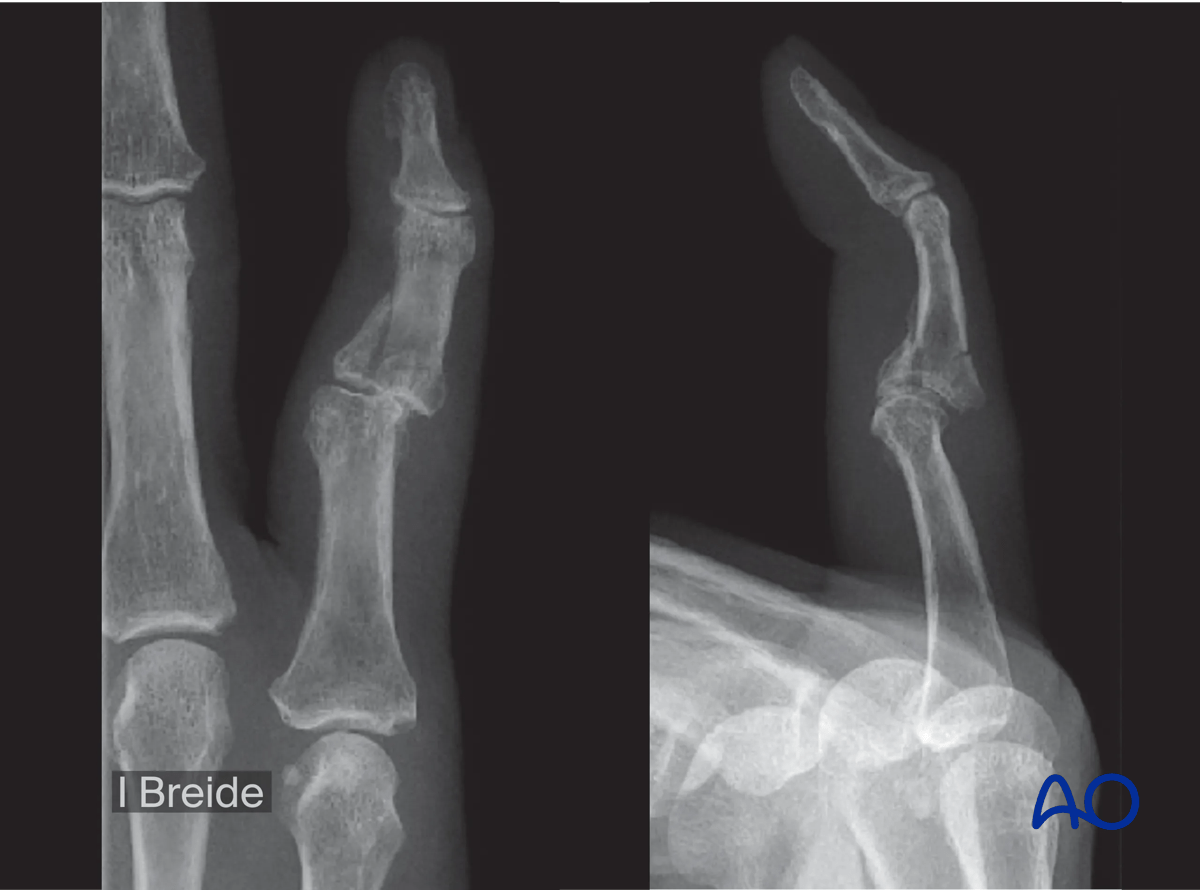 Dynamic external fixation of a multifragmentary complete articular fracture of the middle phalangeal base.