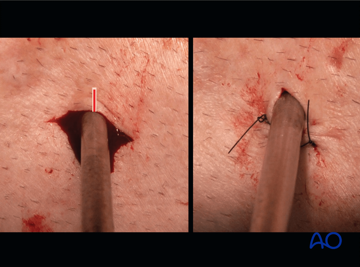 Proximal tibia: Pin insertion
