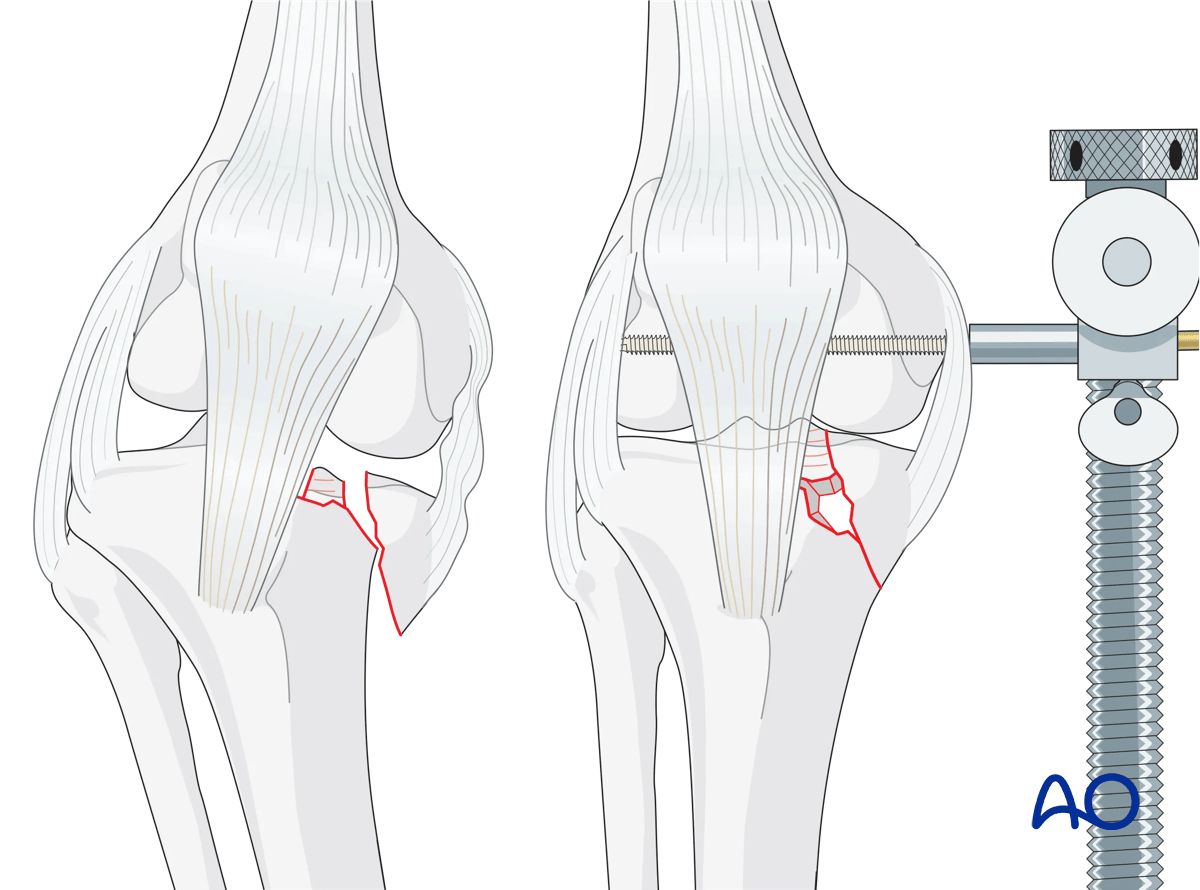 ORIF - Conventional plating, preliminary reduction