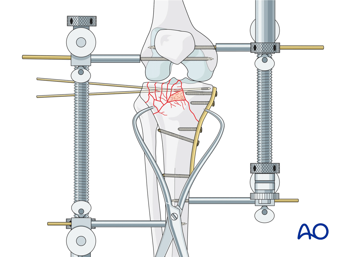 ORIF - Conventional plating, reduction of lateral column