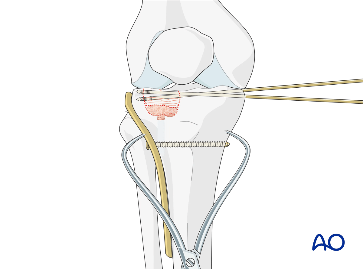 ORIF - Conventional plating, fixation of the lateral articular surface