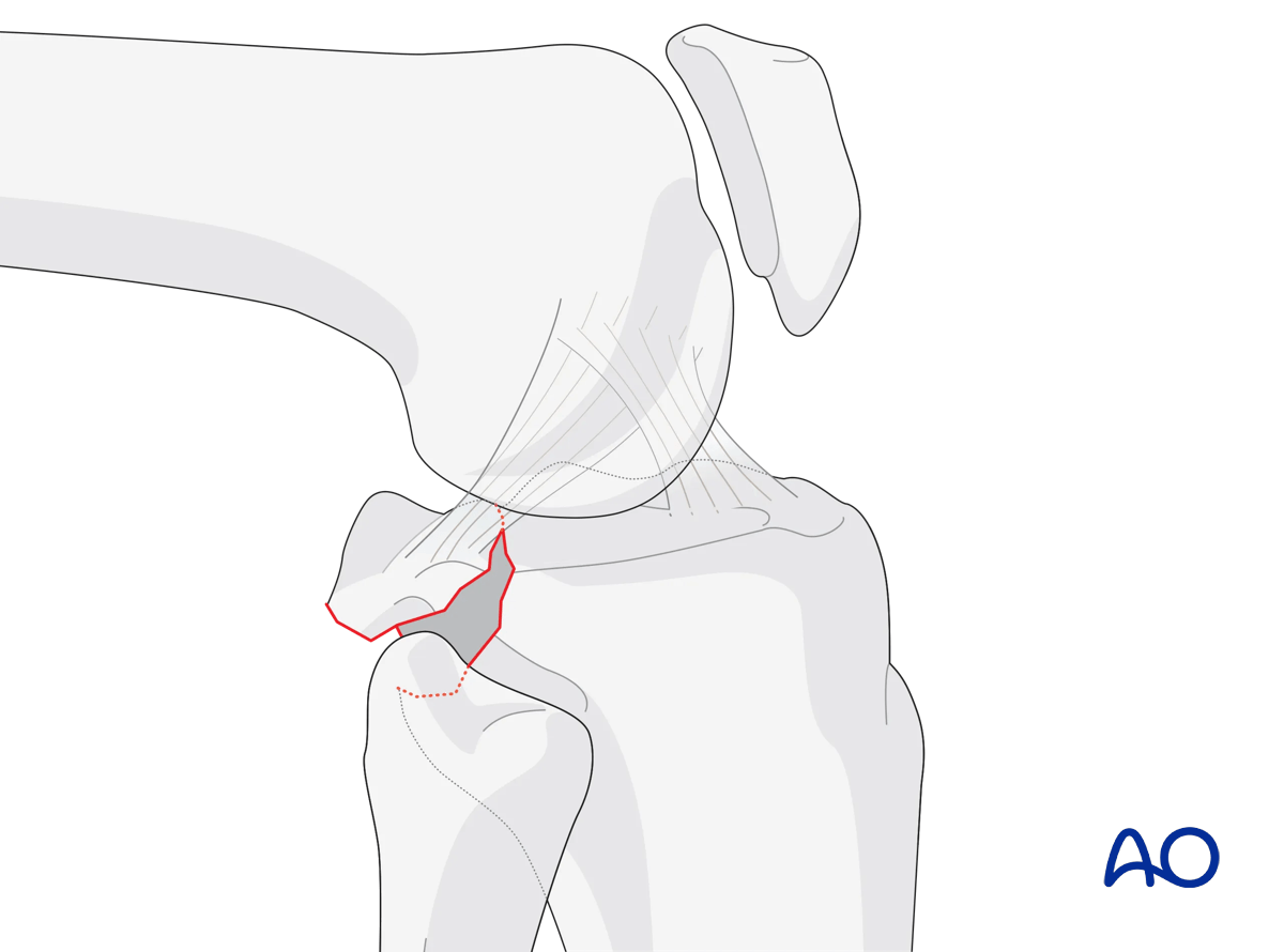 Posterior cruciate ligament avulsion