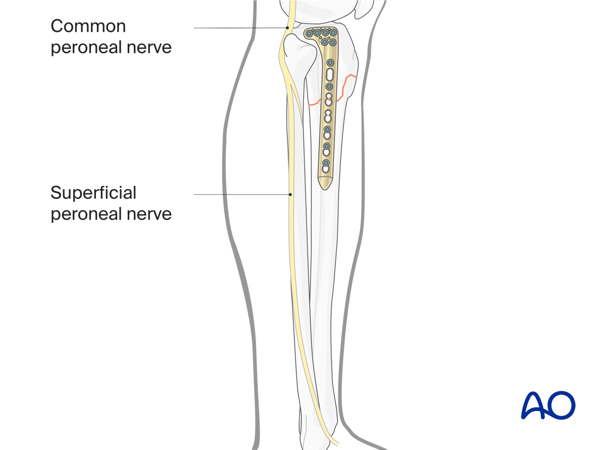 Proximal tibia: complete articular fracture - Angular stable plating – anatomical hazards