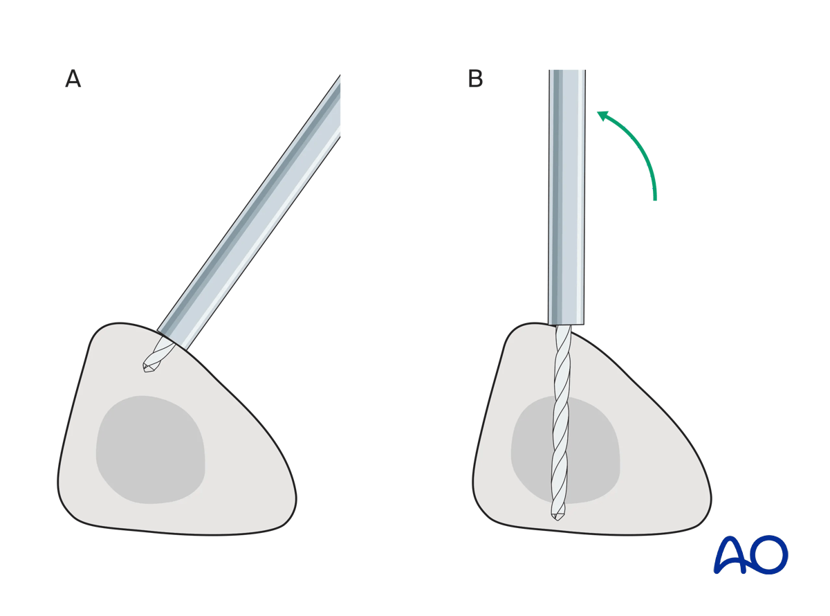 Tibia: temporary bridging external fixator: pin placement