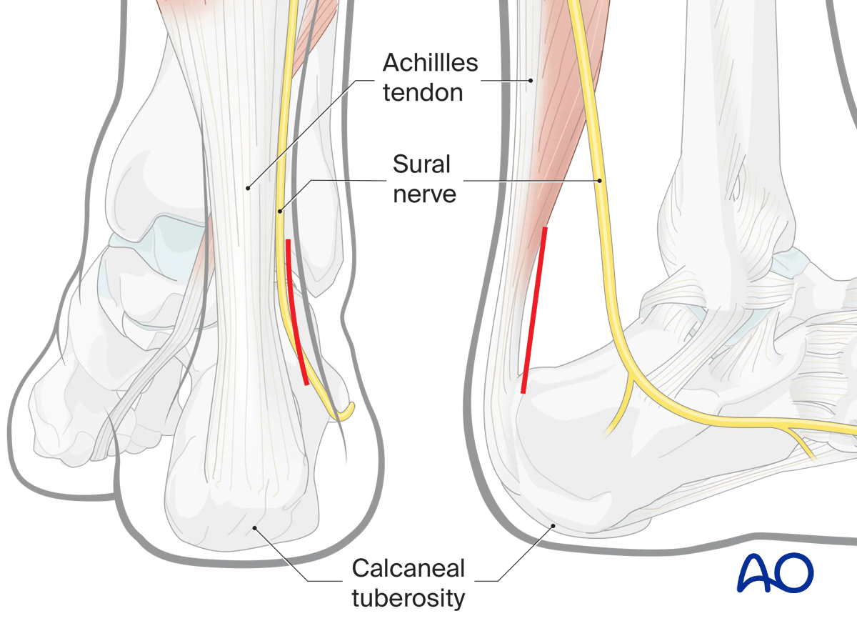 MIO posterior approach: incision landmarks Achilles tendon and calcaneal tuberosity.