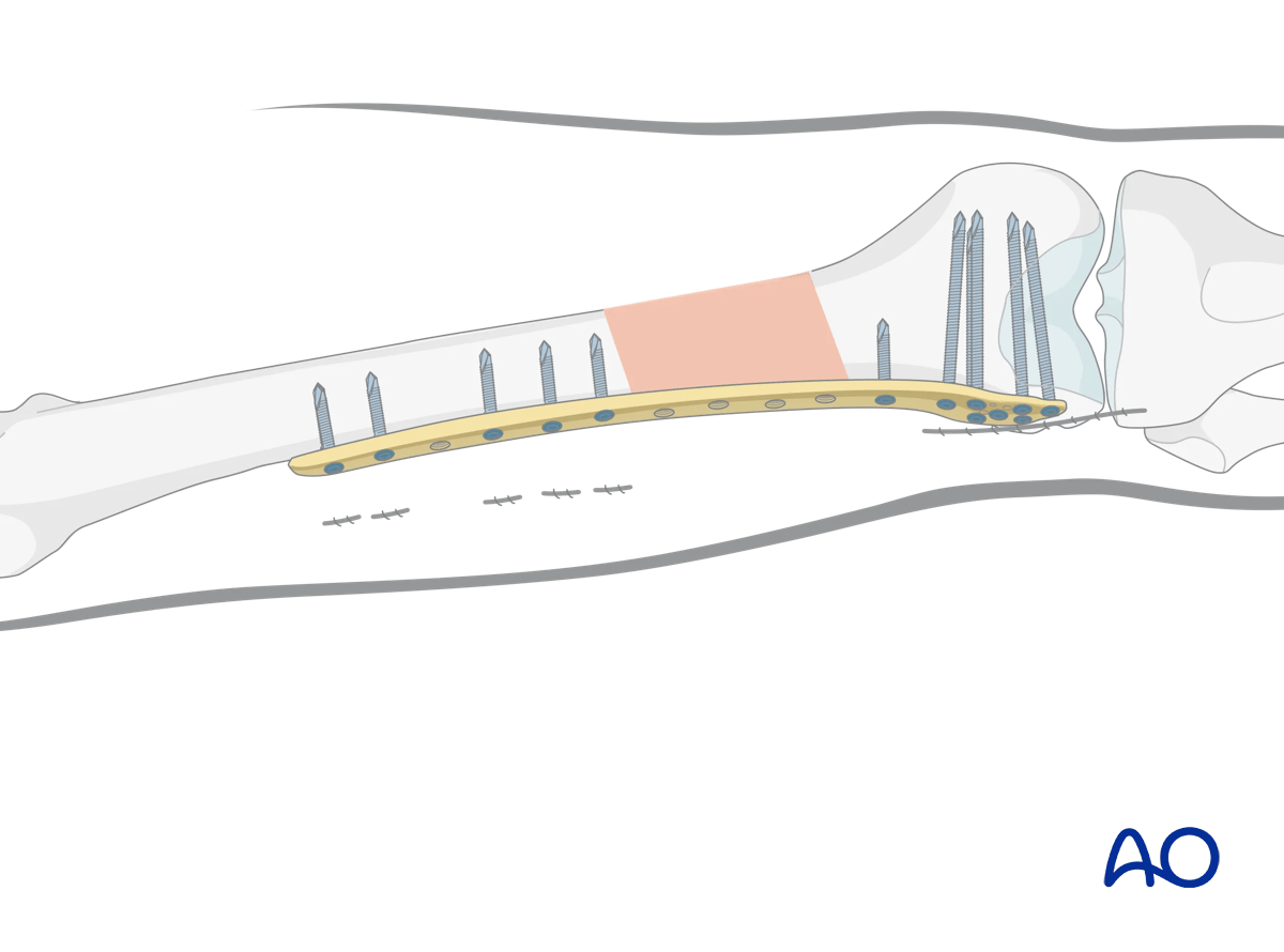 MIO - Bridge plating (LISS or LCP) for a distal 1/3 fracture of the femur