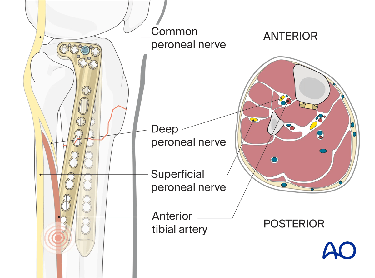 Proximal tibia: complete articular fracture - Angular stable plating – plate positioning