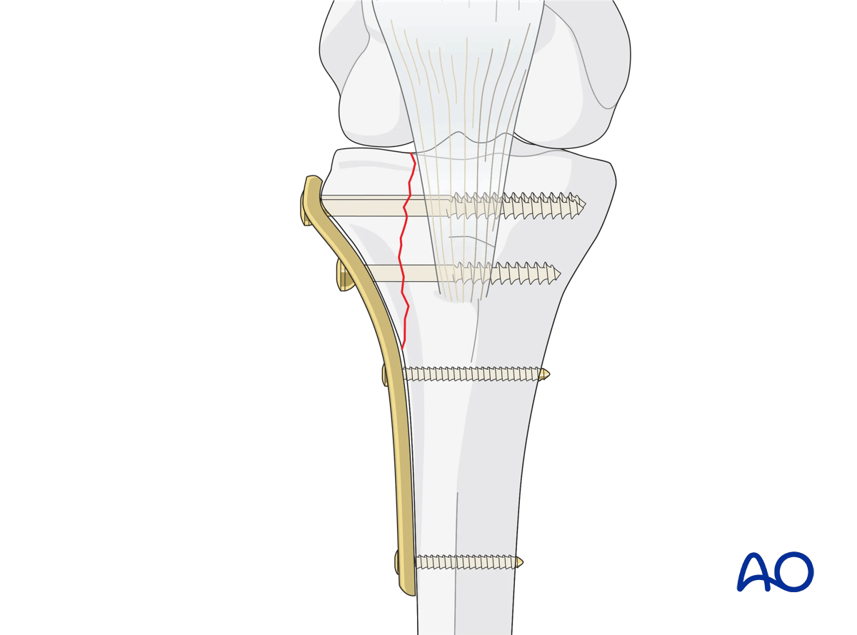 ORIF - Conventional plating, general considerations