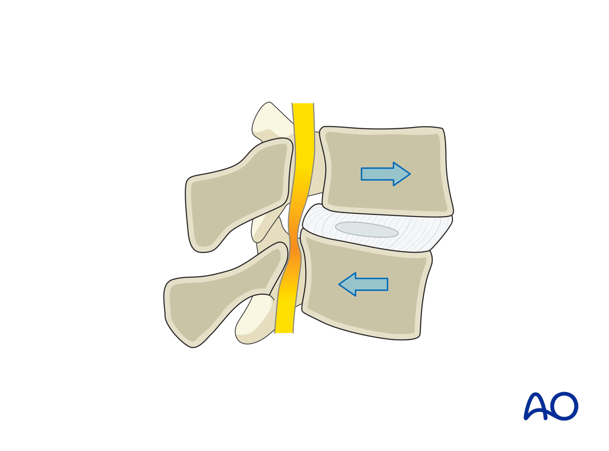 Lumbar spinal stenosis with spondylolisthesis